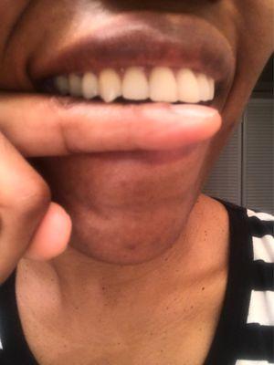 All this black space below my right lateral incisor - where tooth enamel used to be!