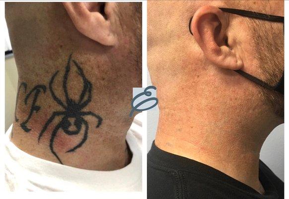 Laser tattoo removal at Erasable Inc.