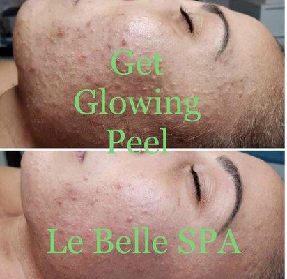 Glowing Micro-Peel