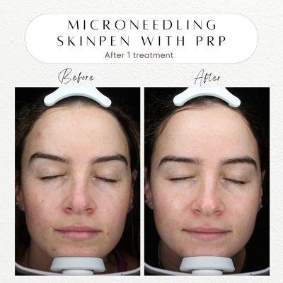 Before and after microneedling skinpen with prp