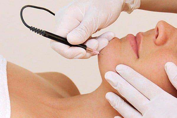 Permanent hair removal using our 27mhz Apilus electrolysis machines