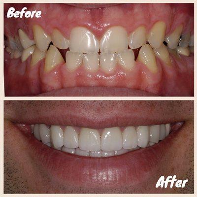 Smile Transformation with crowns and veneers