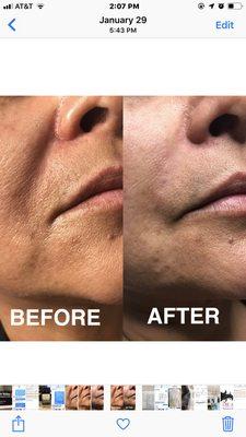 Nasolabial fold Dermal Fillers by Ellen