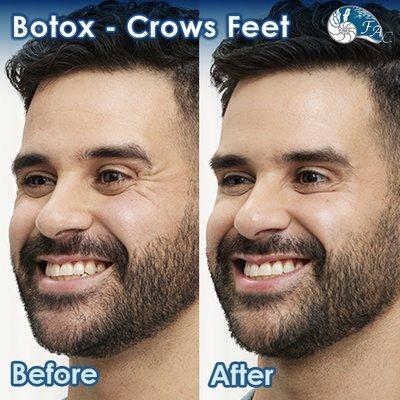 Botox: Crows Feet - Before & After Results Please Call (949) 313-2600