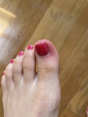 Infected toe from pedicure. I'm on antibiotics now.