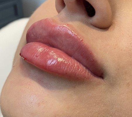 Lip Augmentation by Nurse Fay.