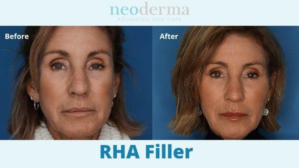 Get a fresh, rejuvenated look with the newest RHA filler. Give us a call at 714-533-4777 to book an appointment