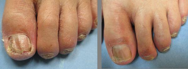 Laser Fungus Before & After 3 treatments.