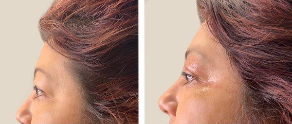 Plama pen upper eyelid treatment.  Pictures taken immediately before and after treatment