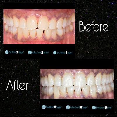 #invisaligndentist #beforeandafter