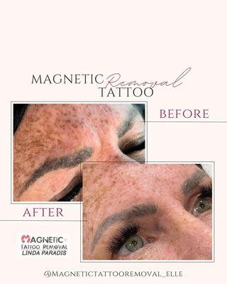 Magnetic Tattoo Removal Examples