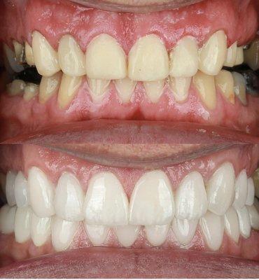 Full mouth rejuvenation with veneers and crowns