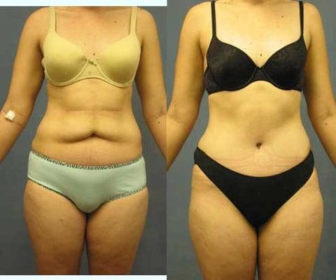 Abdominoplasty