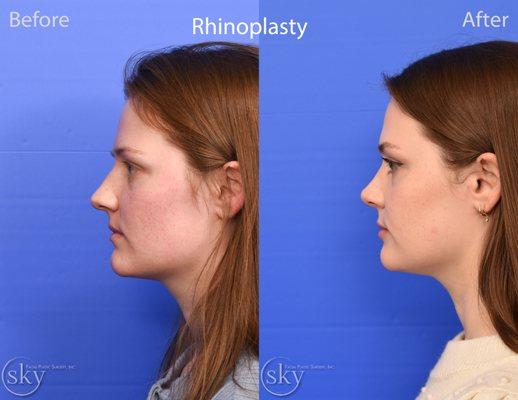 SKY Finesse rhinoplasty