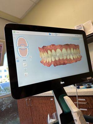 Invisalign scan