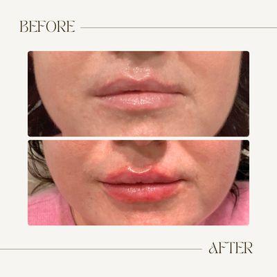 Lip filler before and after