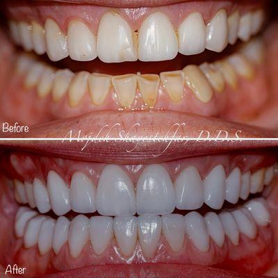 Smile transformation by veneers and crowns!