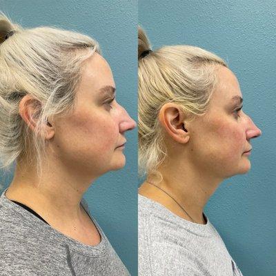 Kybella injection