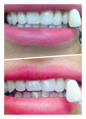 Sorry!!! food in my tooth, before pic, top pic. After pic