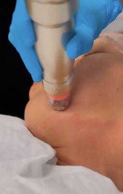 Sylfirm X RF Microneedling for texture, skin tightening and collagen production.