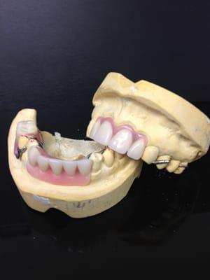 Temporary Partial Dentures - Made by our In-House Lab.