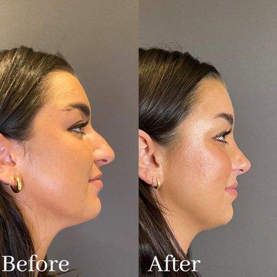 Female After 1 year Closed Scarless Rhinoplasty +Septoplasty.