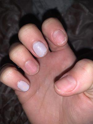 Nails peeling