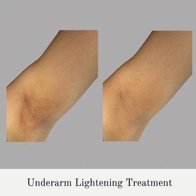 Underarm Lightening Treatment