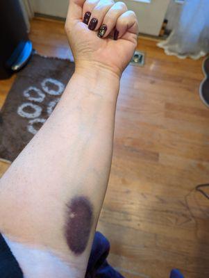 This is a hematoma that I got recently from a blown vein while trying to place IV.  She decided to "try it" anyway and this happened.