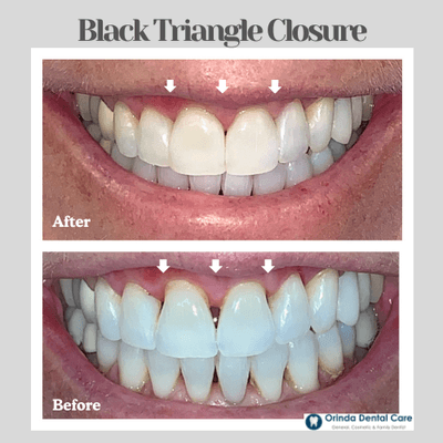 Closing Black Tiangle Spaces Between Front Teeth