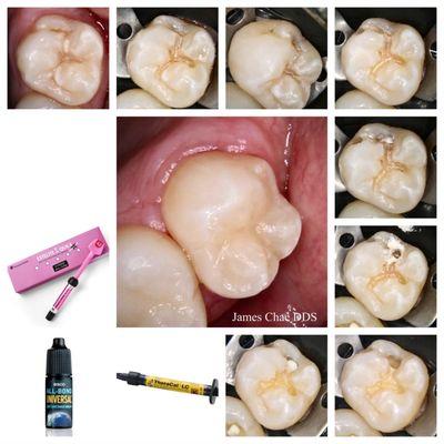 Hidden caries. It is very common to find caries on the distal pit.