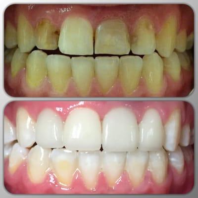 4 all porcelain crowns to address fractures and decay