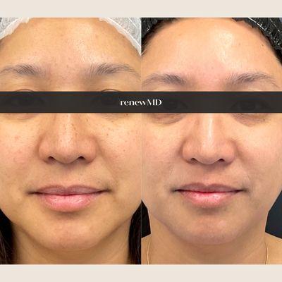 Dark Spots, Hyperpigementation fading using Picosure Pro laser. RenewMD is nationally recognized for laser resurfacing for darker skin tone