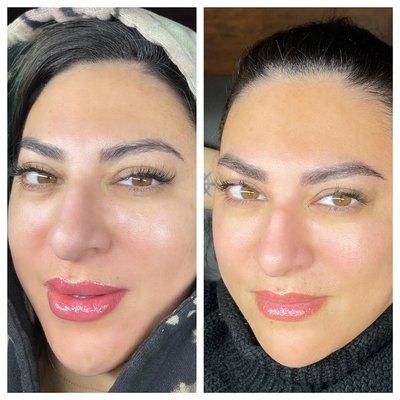 Fresh and healed results of one session of lip blush