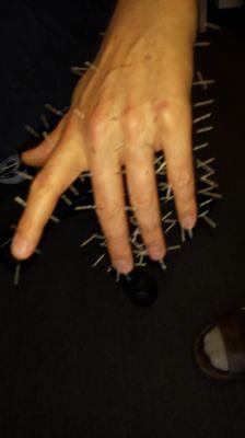 Hand acupuncture