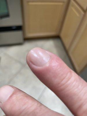 infection from manicure