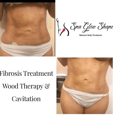 W O W ! Look at these amazing results after just her 2nd treatment. Fibrosis treatment combined with Wood Therapy & Cavitation Therapy