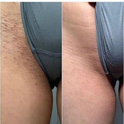 Laser hair removal will leave your skin smooth & sexy.