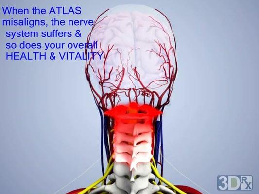 Head and neck pain is often the result of atlas subluxation (spinal misalignment).  We can help! Gentle and specific corrections