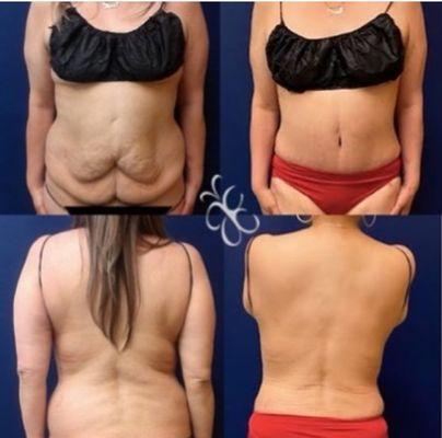 50 year old lovely lady with a lot of loose skin, stretch marks, & double rolls of tummy, underwent a full tummy tuck and lipo of her waist!