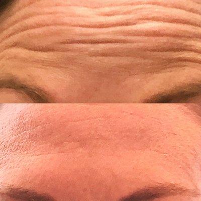 Beautiful wrinkle free forehead. Treated with Botox.