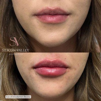 Lip Augmentation