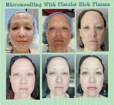 Microneedling with Platelet Rich Plasma