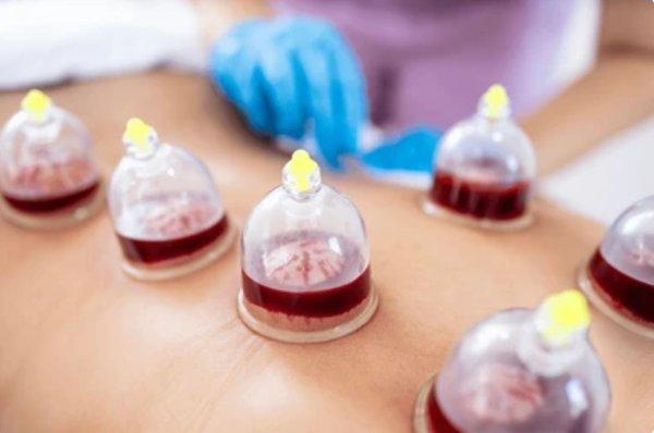 Wet Cupping/Hijama Therapy for pain and stress relief.