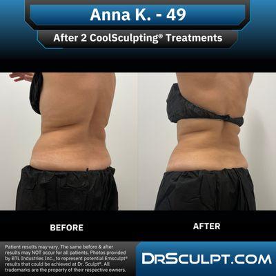 After 2 CoolSculpting treatments on abdomen/flanks