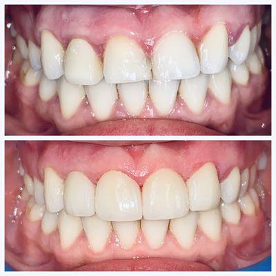 Four porcelain crowns to correct flaring and missing lateral incisor.  Dr. Mark Ajlouni.