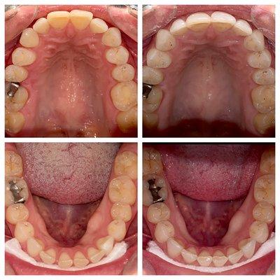 Gaps closed, teeth straightened in 4 months with Invisalign.