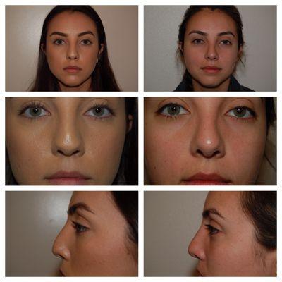 Rhinoplasty (Open)