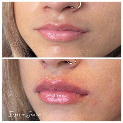 Lip Filler