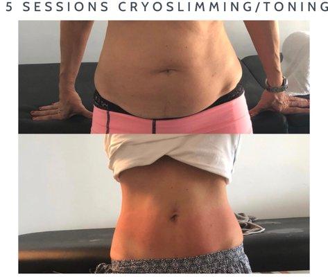 Real results after 5 sessions of Cryoslimming/Cryotoning!